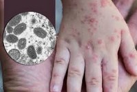 Bộ Y tế xếp bệnh đậu mùa khỉ vào bệnh truyền nhiễm nhóm B