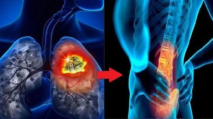 5 triệu chứng cảnh báo ung thư phổi di căn xương. 