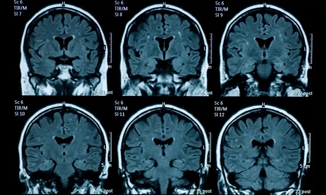 Dấu hiệu lão hóa sớm ở não bộ thanh thiếu niên sau đại dịch Covid-19