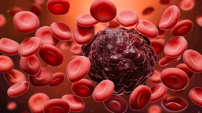 Ung thư máu bắt nguồn từ bất thường xảy ra tại tủy xương- nơi sản sinh ra các tế bào máu (Ảnh: Medenta).