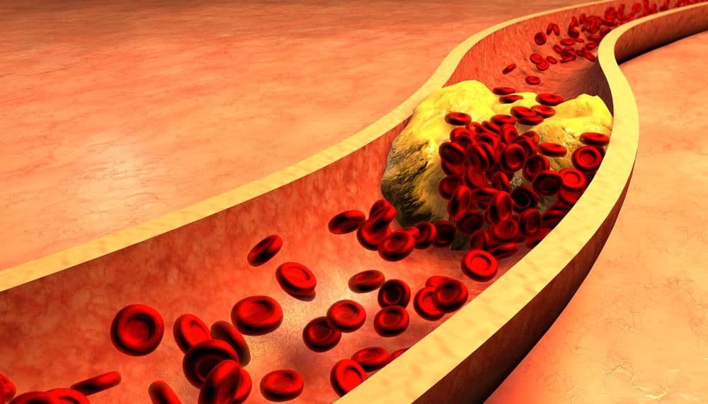 Bệnh tăng cholesterol máu gia đình di truyền: Nguy cơ tử vong cao do không được điều trị đầy đủ