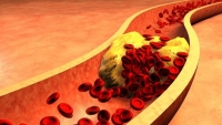 Bệnh tăng cholesterol máu gia đình di truyền: Nguy cơ tử vong cao do không được điều trị đầy đủ