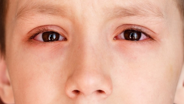 Nguyên nhân trẻ bị viêm kết mạc (đau mắt đỏ) cấp và cách phòng bệnh đúng