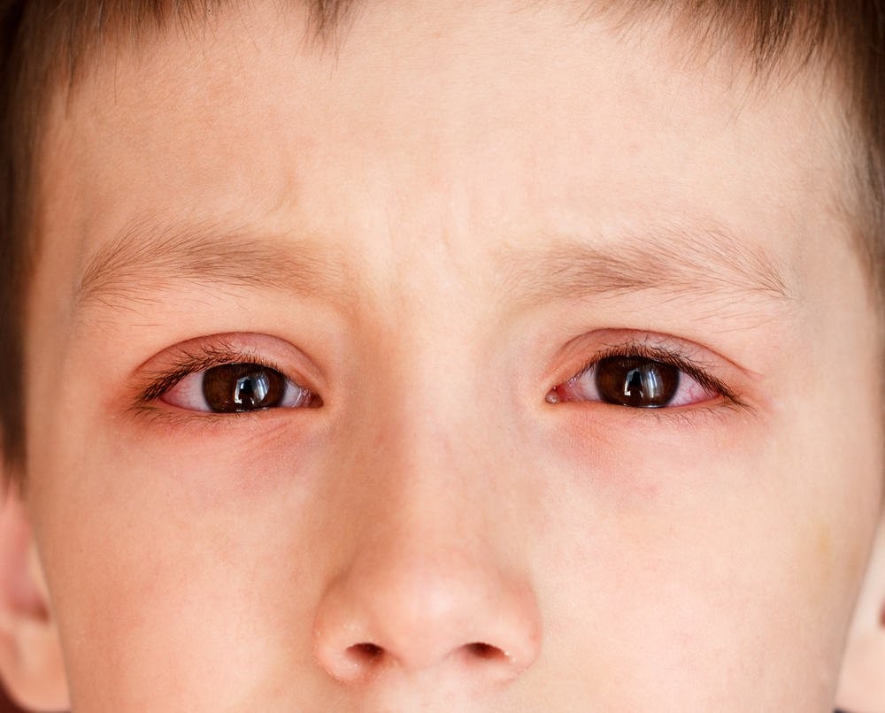 Viêm kết mạc (còn gọi là đau mắt đỏ) có thể do các tác nhân gây bệnh như vi khuẩn, virus, nấm, ký sinh trùng… (Nguồn: SKĐS)