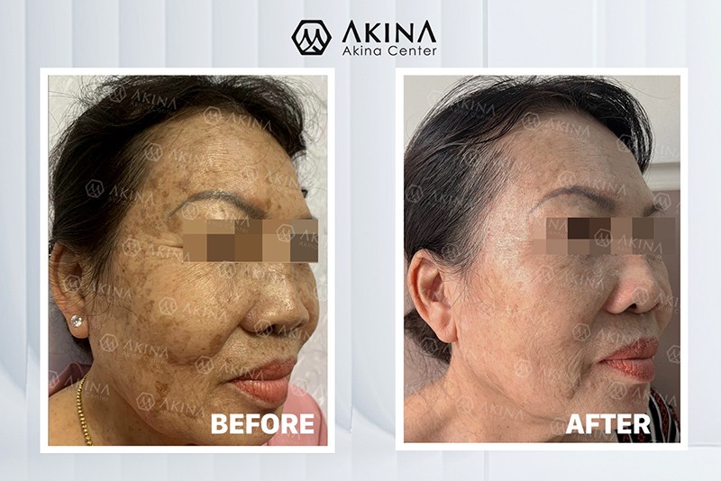 The effectiveness of skin treatment with Dr. Cao Nguyen (Source: AKINA Center)