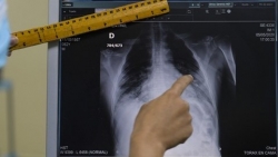 Các bác sĩ X-quang tại Nga có cơ hội sử dụng AI để xác định 54 loại bệnh