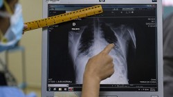 Các bác sĩ X-quang tại Nga có cơ hội sử dụng AI để xác định 54 loại bệnh