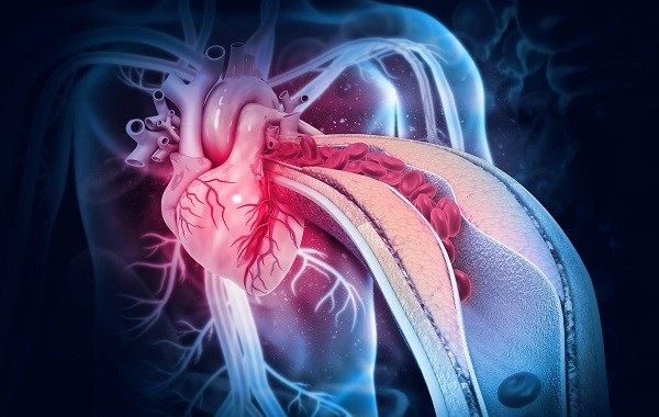 Nhồi máu cơ tim là một cấp cứu nội khoa rất nặng, đe dọa tính mạng. (Nguồn: SKĐS)