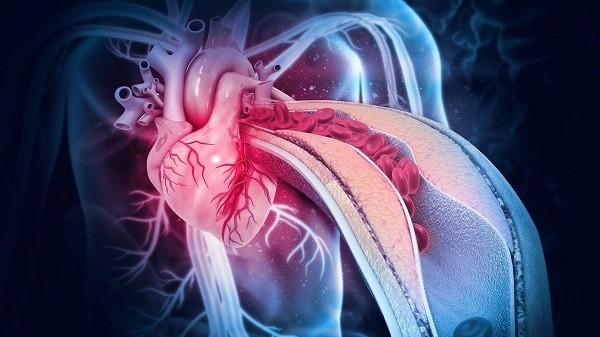 Chuyên gia tư vấn nguyên nhân và cách phòng bệnh nhồi máu cơ tim cấp