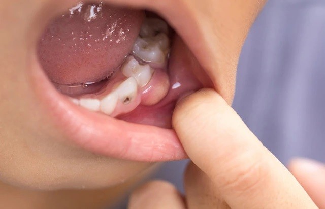 Viêm lợi nặng nếu không điều trị có thể dẫn đến các vấn đề răng miệng nguy hiểm. (Nguồn: SK&ĐS)
