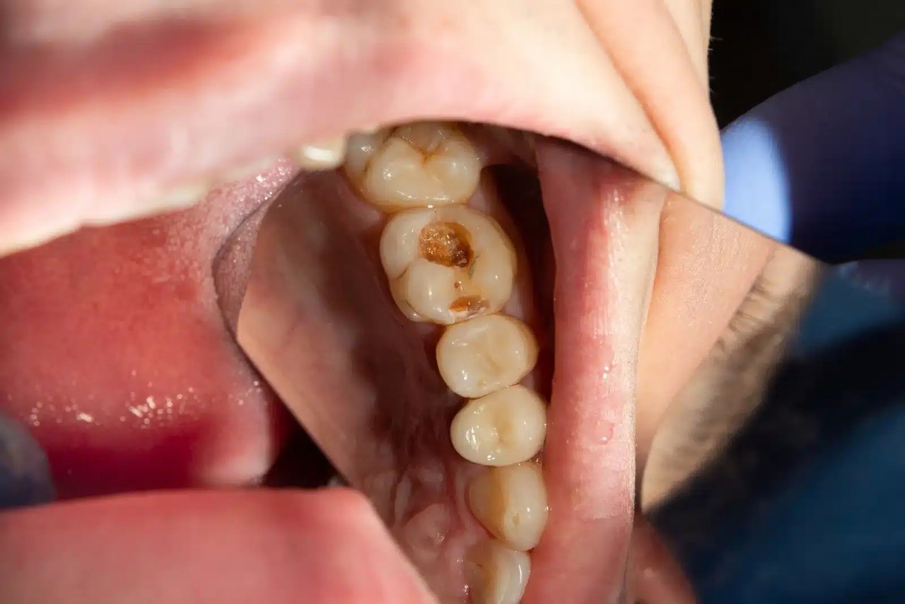 Những bệnh về răng miệng nghiêm trọng cần phát hiện sớm
