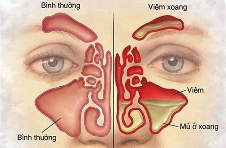 Viêm xoang là tình trạng viêm nhiễm của xoang cạnh mũi, niêm mạc mũi. (Nguồn: medlatec)