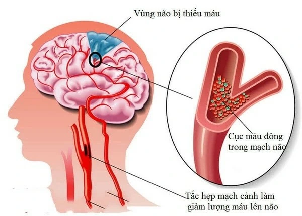 Chuyên gia tư vấn về nguyên nhân và biện pháp giảm nguy cơ thiếu máu lên não