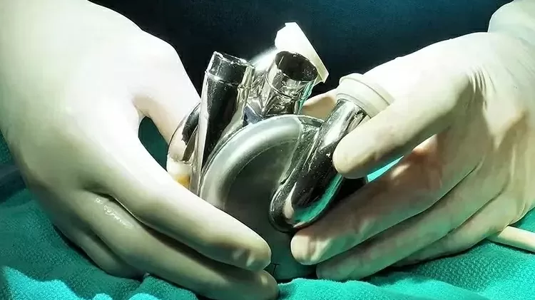 Bệnh nhân đầu tiên trên thế giới xuất viện và sống sót 100 ngày với trái tim nhân tạo làm từ titan
