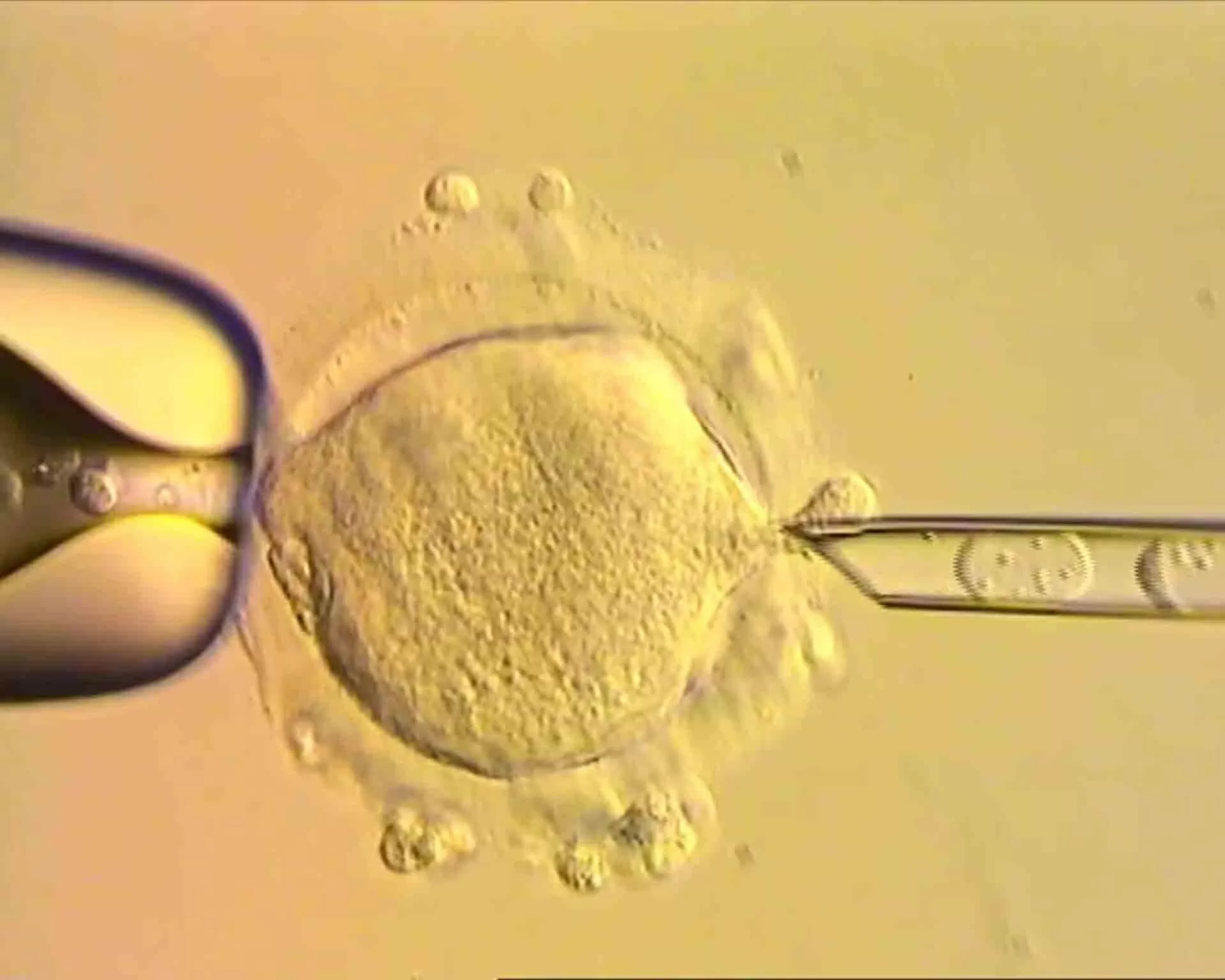Liệu pháp hiến tặng ty thể cho phép tạo phôi IVF mang ADN từ ba người, nhằm ngăn ngừa các bệnh di truyền nghiêm trọng. (Nguồn: Đại học Newcastle) Liệu pháp hiến tặng ty thể cho phép tạo phôi IVF mang ADN từ ba người, nhằm ngăn ngừa các bệnh di truyền nghiêm trọng. (Nguồn: Đại học Newcastle)