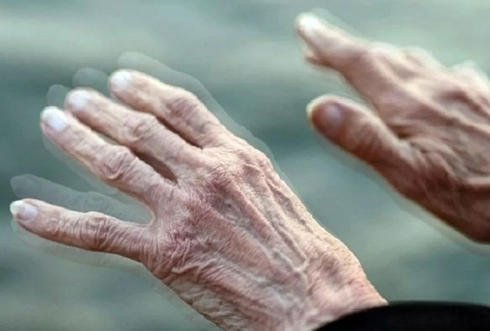 Lần đầu quan sát được mồi lửa khởi phát bệnh Parkinson Lần đầu quan sát được mồi lửa khởi phát bệnh Parkinson