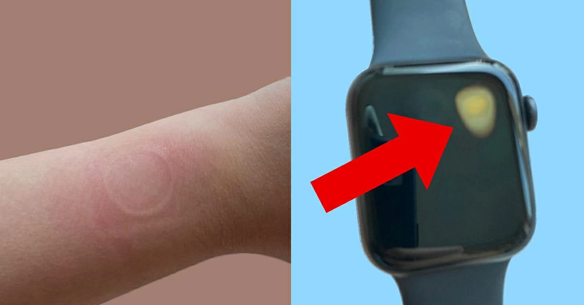 Một người dùng Reddit chia sẻ trải nghiệm bị Apple Watch gây bỏng cổ tay nghiêm trọng. 