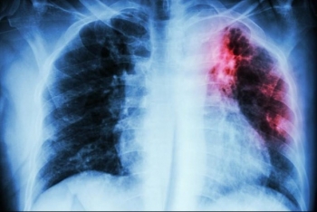 Trung Quốc xác định loại gene quan trọng mở ra hướng điều trị cho bệnh nhân ung thư phổi