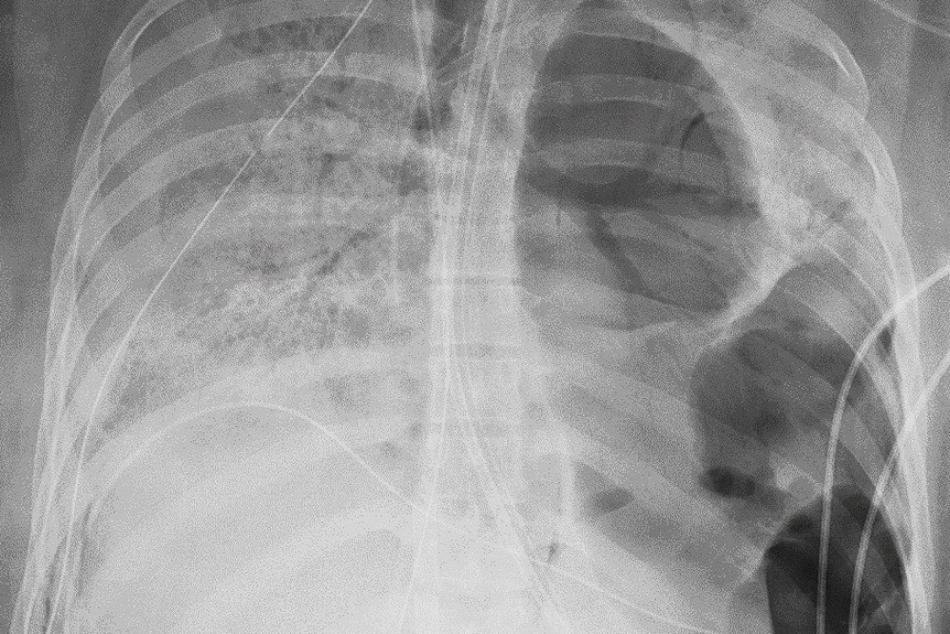Ảnh chụp X-quang phổi của một bệnh nhân bị COVID-19 cho thấy các mảng trắng, nơi có dịch, mủ, chất nhầy và các tế bào phổi chết đang làm suy giảm quá trình vận chuyển oxy. (Nguồn: AP)