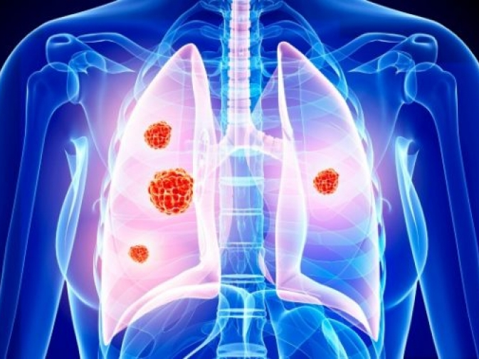 ​Phát hiện hormone giúp tăng hiệu quả hóa trị điều trị ung thư phổi