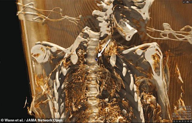Xác ướp 500 năm tuổi ở Greenland được xác định bị xơ vữa động mạch