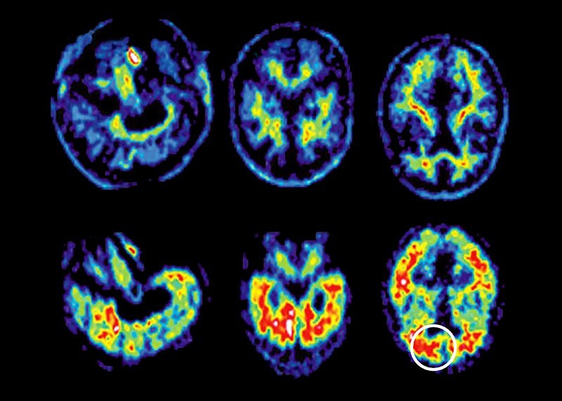 Chụp PET (chụp cắt lớp phát xạ positron) não của một người bị bệnh Alzheimer cho thấy sự tích tụ của các mảng amyloid (khoanh tròn) không có trong não khỏe mạnh. (Nguồn: SSPL)