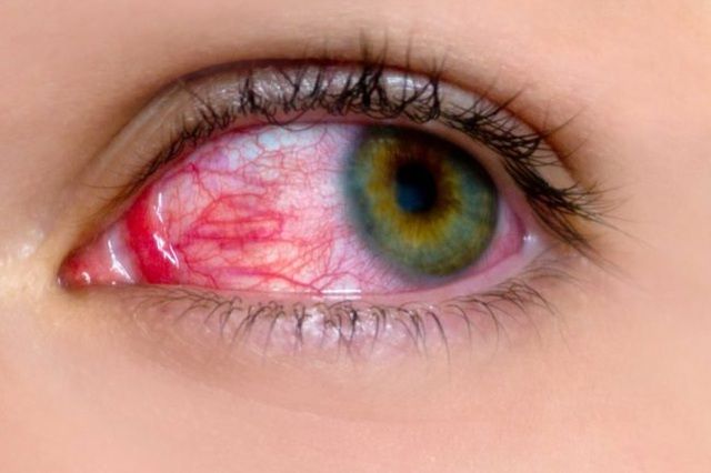 Cảnh báo bệnh lý về mắt thường bùng phát 10 ngày sau bão lũ