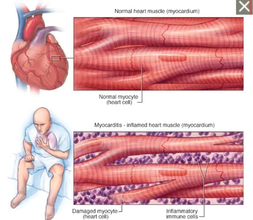 Nhóm người nào dễ mắc viêm cơ tim sau tiêm vaccine Covid-19?