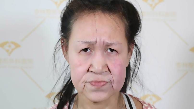 Trung Quốc: 'Choáng' với khuôn mặt sau phẫu thuật của thiếu niên 15 tuổi nhìn như bà già 60