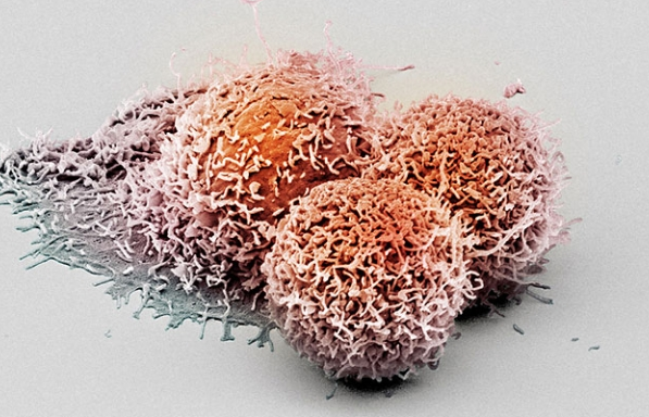 Các nhà khoa học Thụy Sỹ phát hiện protein mới chống ung thư gan