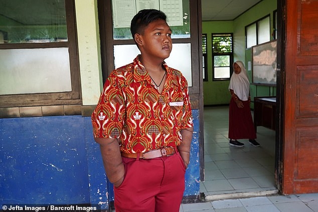 indonesia cau be gay soc sau khi giam can den hon 1 ta