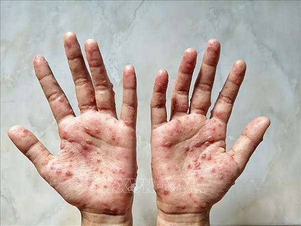 Health Ministry recommends measures to prevent monkeypox