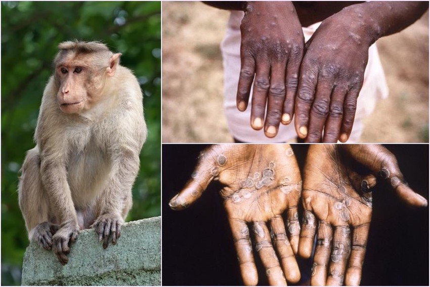 Các chuyên gia nổi tiếng về bệnh truyền nhiễm kêu gọi hệ thống y tế thế giới hành động sớm để ngăn chặn bệnh đậu mùa khỉ, rút kinh nghiệm từ đại dịch Covid-19. (Nguồn: Collage)