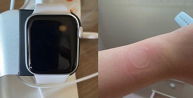 dong ho gia re apple watch se khien nguoi dung bi bong do qua tai nhiet