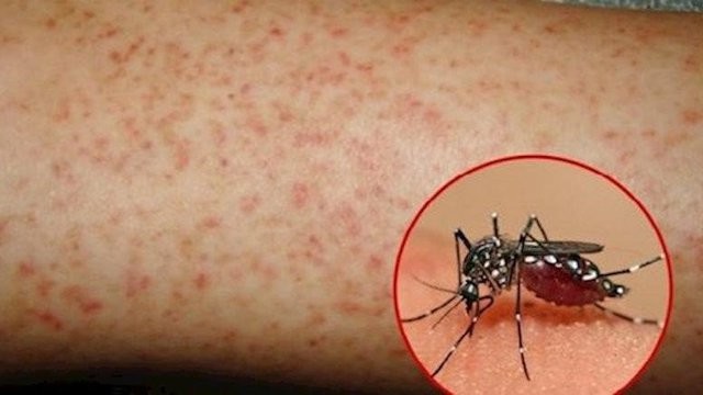 Chuyên gia tư vấn các triệu chứng bệnh và biện pháp ngăn muỗi gây bệnh sốt xuất huyết. (Nguồn: suckhoedoisong)