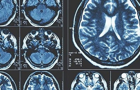 Người có đột biến hiếm gặp gần như chắc chắn mắc bệnh Parkinson